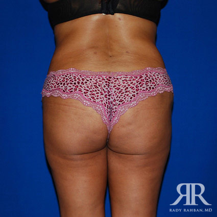 Liposuction