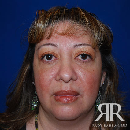 Browlift results on patient