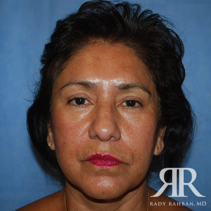 Browlift results on patient