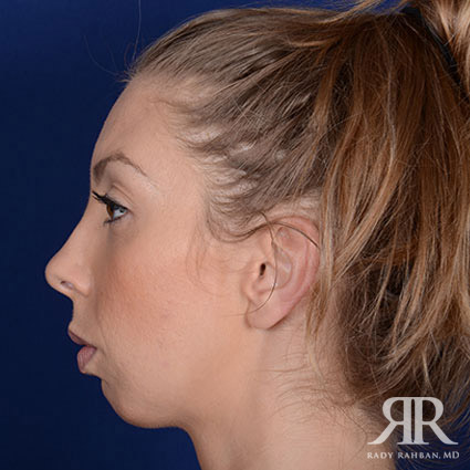 Chin Augmentation