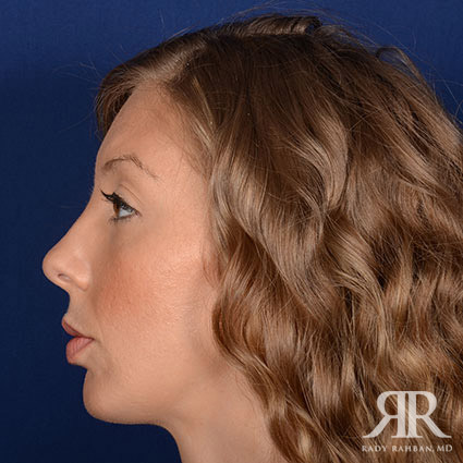 Chin Augmentation