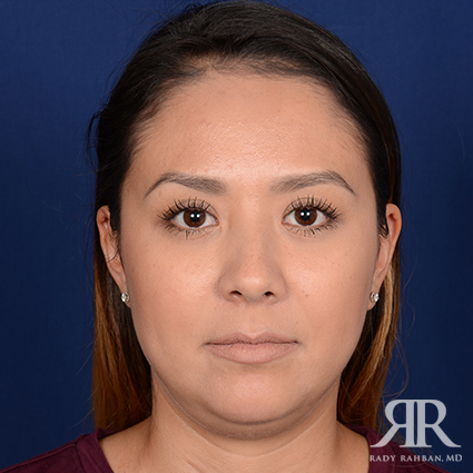 Chin Augmentation