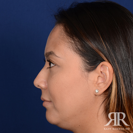 Chin Augmentation