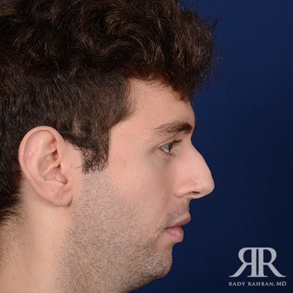 Chin Augmentation