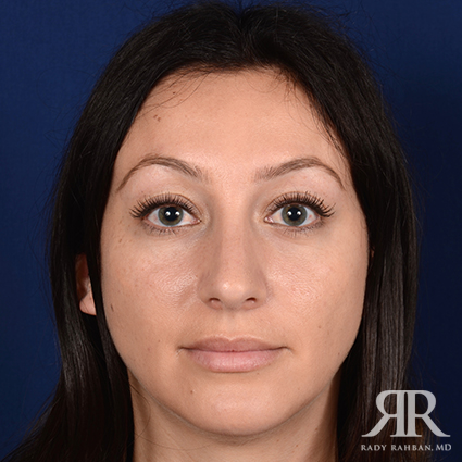 Chin Augmentation