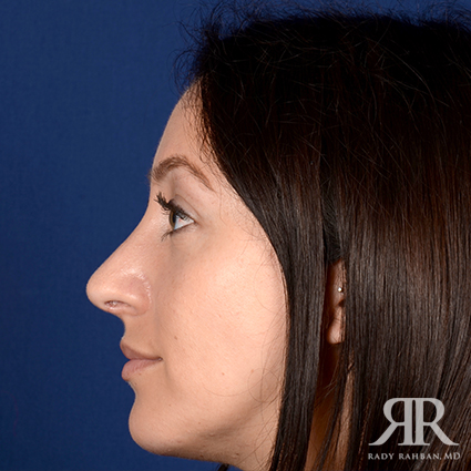 Chin Augmentation