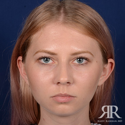 Chin Augmentation