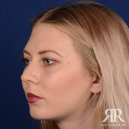 Chin Augmentation