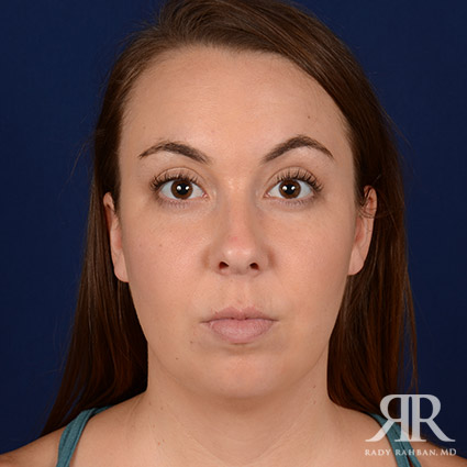 Chin Augmentation