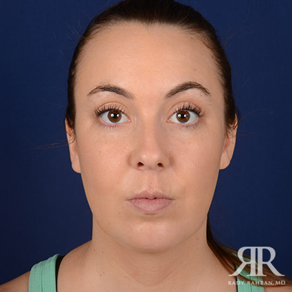 chin augmentation results on patient