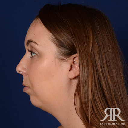 Chin Augmentation