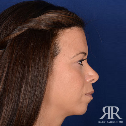 Chin Augmentation