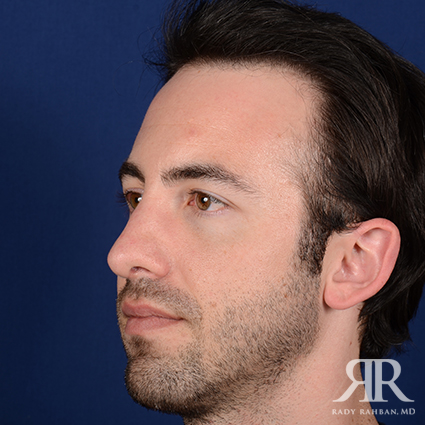 Chin Augmentation