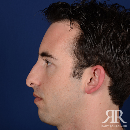 Chin Augmentation