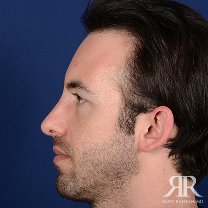 Chin Augmentation