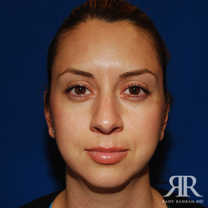 Chin Augmentation