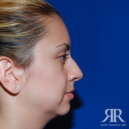 Chin Augmentation