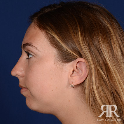 Chin Augmentation