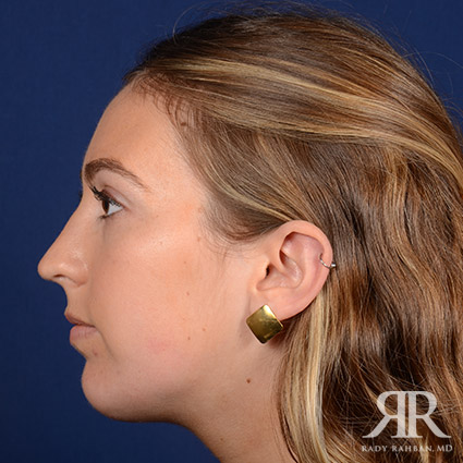 Chin Augmentation