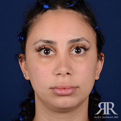 Chin Augmentation