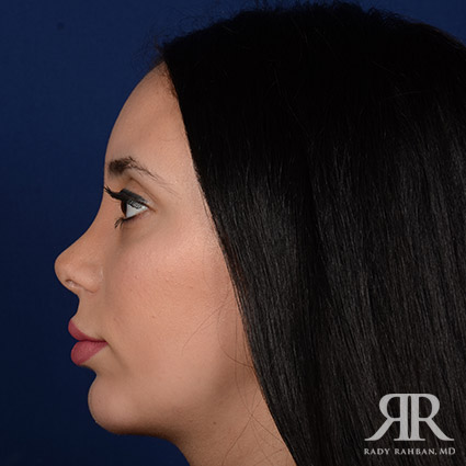 Chin Augmentation