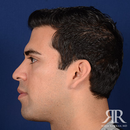 Chin Augmentation