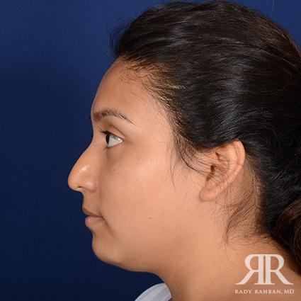 Chin Augmentation