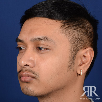 Chin Augmentation