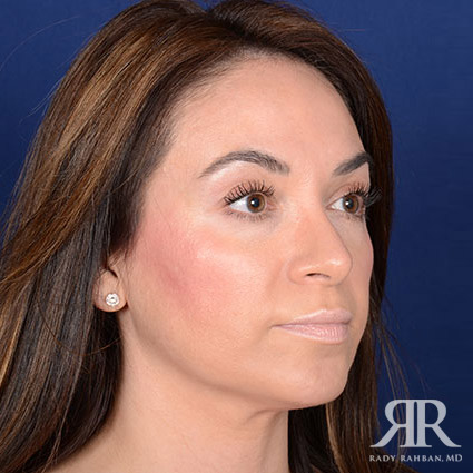 Chin Augmentation