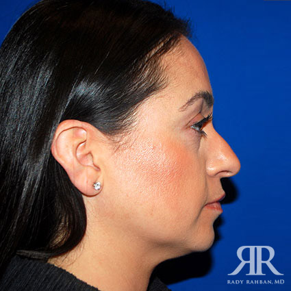 Chin Augmentation