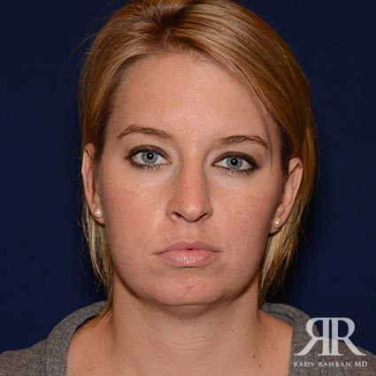 Chin Augmentation