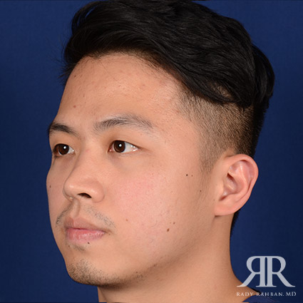 Chin Augmentation