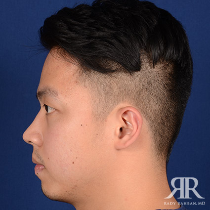 Chin Augmentation