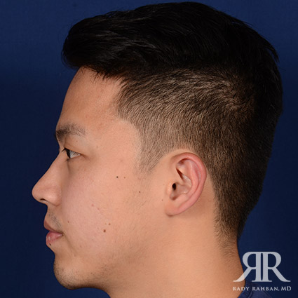 Chin Augmentation