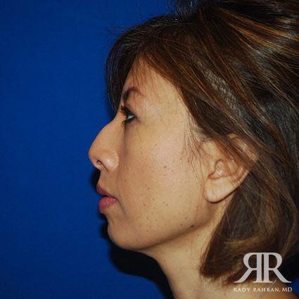 Chin Augmentation