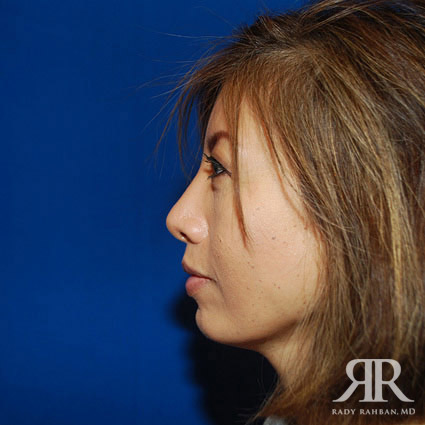 Chin Augmentation