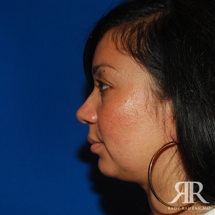 Chin Augmentation