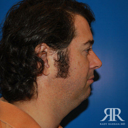 Chin Augmentation