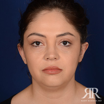 Chin Augmentation