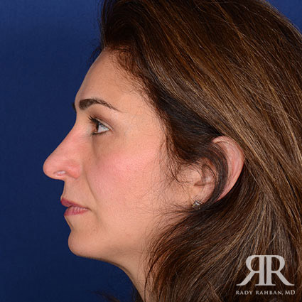 Chin Augmentation