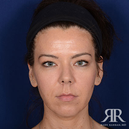 Chin Augmentation