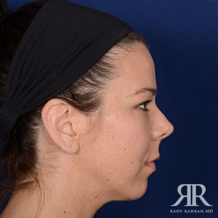 Chin Augmentation