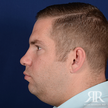 Chin Augmentation