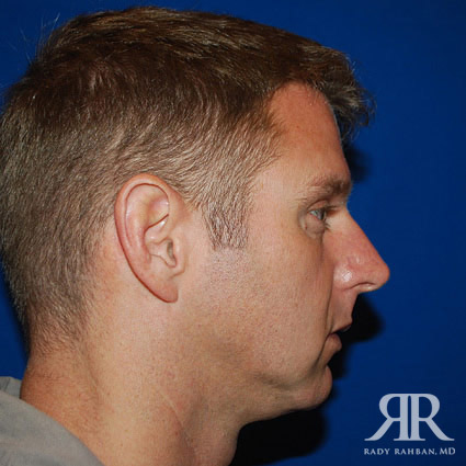 Chin Augmentation