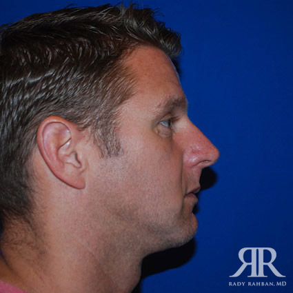 Chin Augmentation