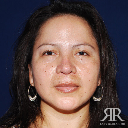 Chin Augmentation