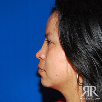 Chin Augmentation