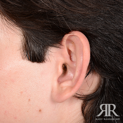 Ear Pinning Surgery