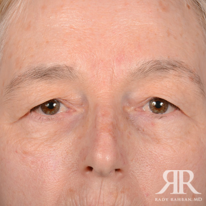 Eyelid Surgery