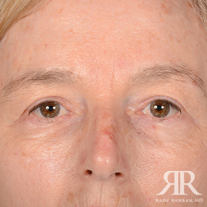 Eyelid surgey results on patient